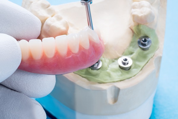 The Safety And Efficacy Of Implant Supported Dentures