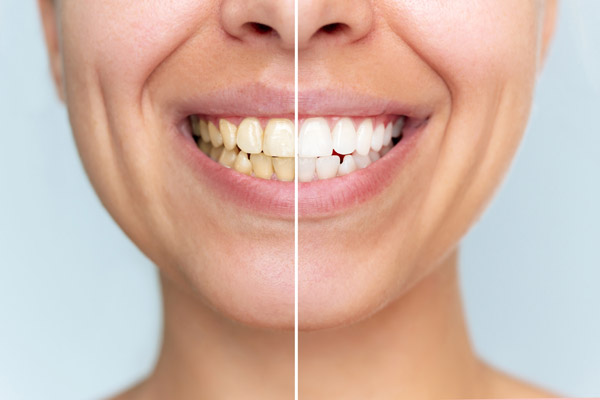 Take Home Teeth Whitening Trays Vs  Over The Counter Whitening Products